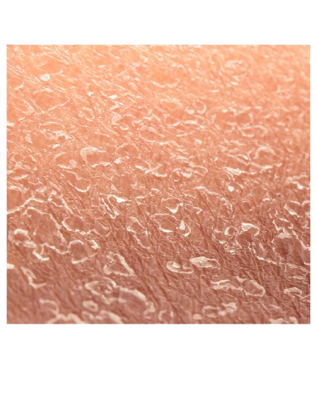 Dry Skin